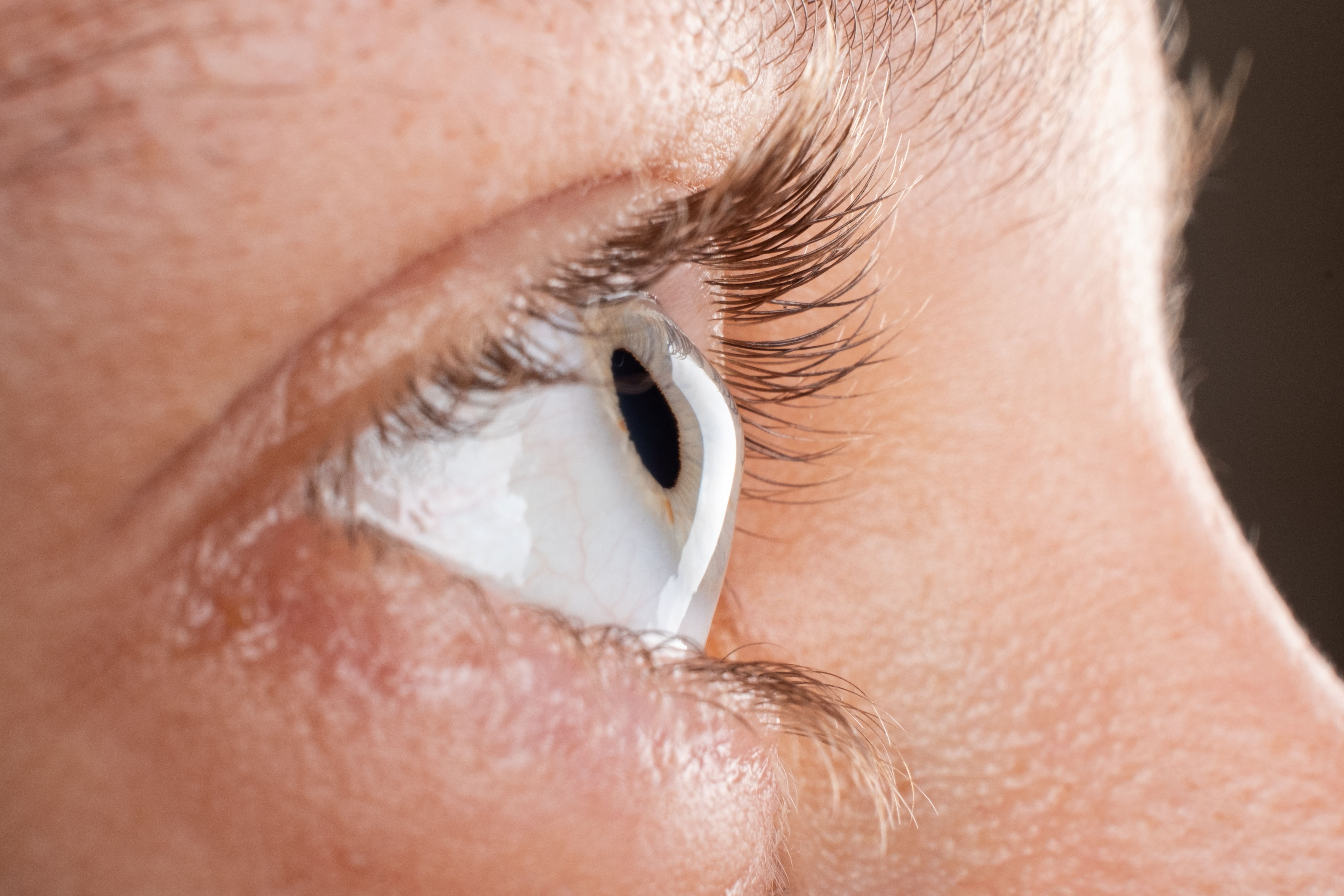 Keratoconus